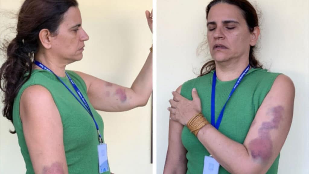 Renata Fernandes com hematomas nos braços após acusar ex-chefe de agressão na TV Câmara de Natal (foto: Arquivo pessoal)