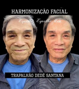 Imagem com foto do antes e depois de Dedé Santana