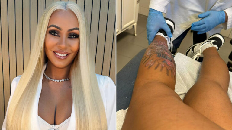 Débora Dunhill sorridente com longo cabelo loiro platinado ao lado de foto de sua perna com tatuagem inflamada em tratamento médico