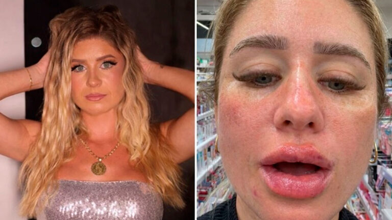 Débora Peixoto posa com as mãos no cabelo usando top prateado e colar, ao lado de imagem com rosto inchado e lábios lesionados após procedimento