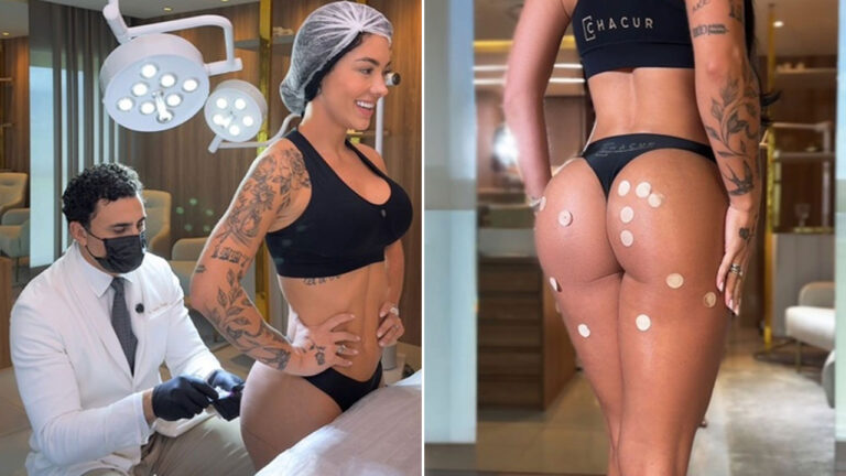 Roberto Chacur de jaleco e máscara aplica procedimento em Rayane Figliuzzi de top preto e touca, ao lado, detalhe dos glúteos com marcações adesivas