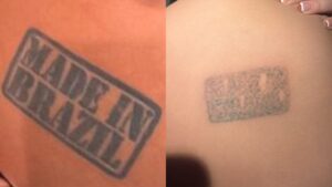 Montagem comparativa mostra a modelo Julia Medeiros com tatuagem Made in Brazil em preto intenso e depois o desenho desbotado após sessões de laser