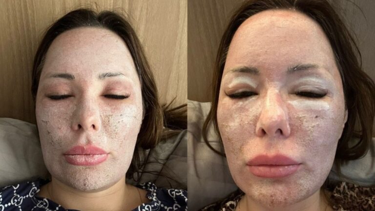 Ju Isen com rosto coberto por produto dermatológico em duas fotos lado a lado durante tratamento de pele com descamação visível