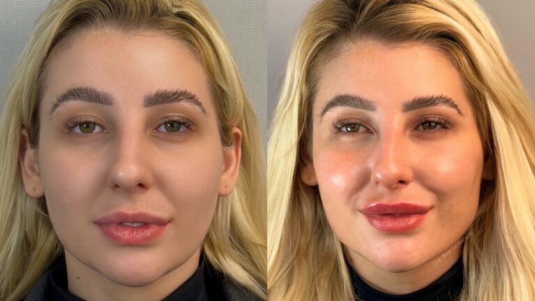 Jéssica de Paula em comparação antes e depois de harmonização facial com close do rosto lado a lado