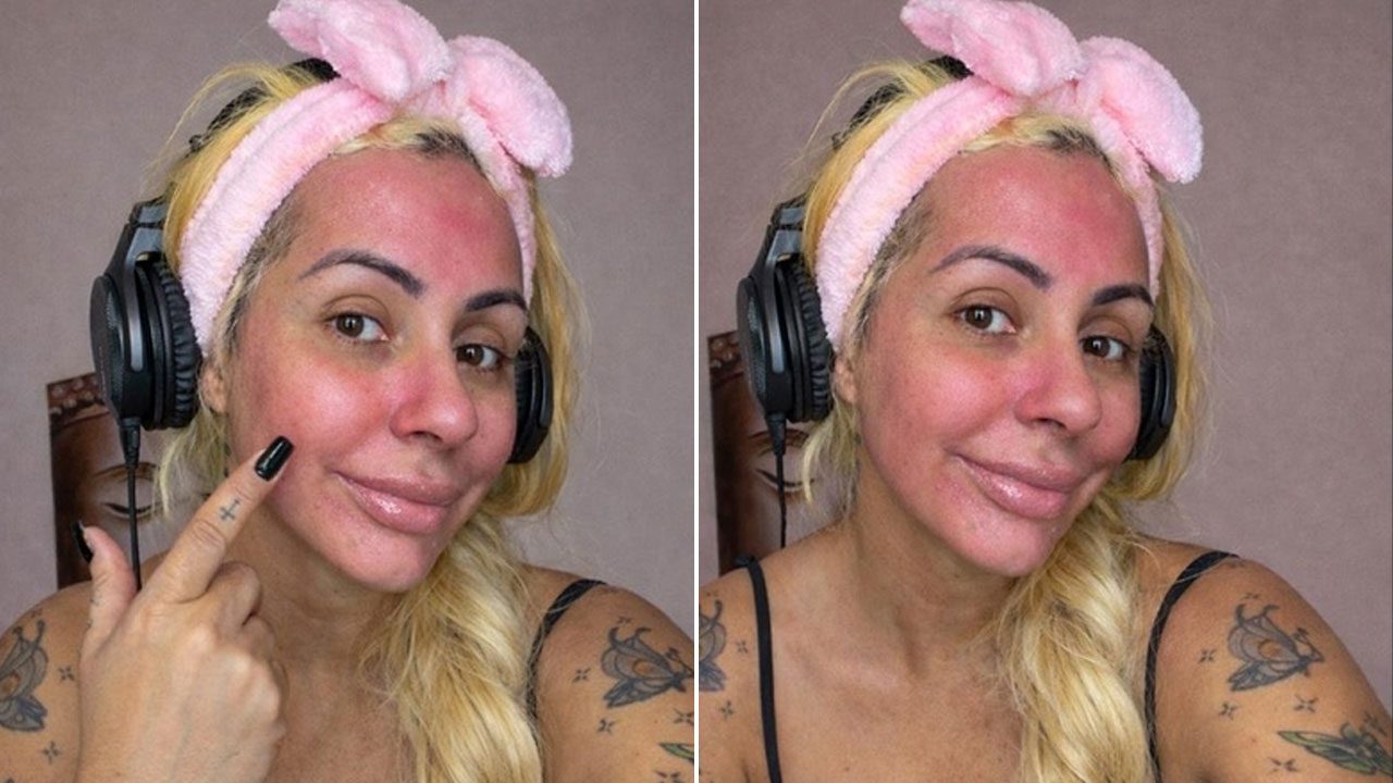 Débora Dunhill aparece em duas selfies lado a lado usando fones de ouvido e faixa rosa no cabelo mostrando o rosto avermelhado e apontando a bochecha