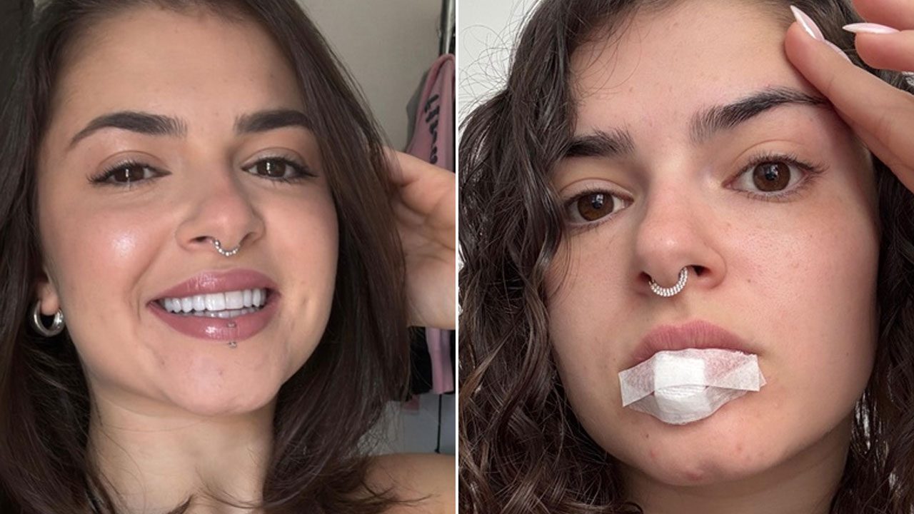 Montagem de fotos da influenciadora Kerolay Chaves; à esquerda, sorrindo e à direita, com curativo na boca após acidente com piercing