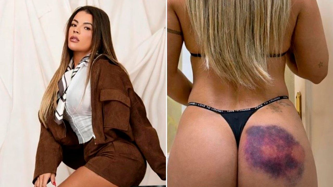Montagem com Rosana Ferreira posando de roupa marrom em estúdio e à direita mostrando hematoma na nádega usando calcinha preta